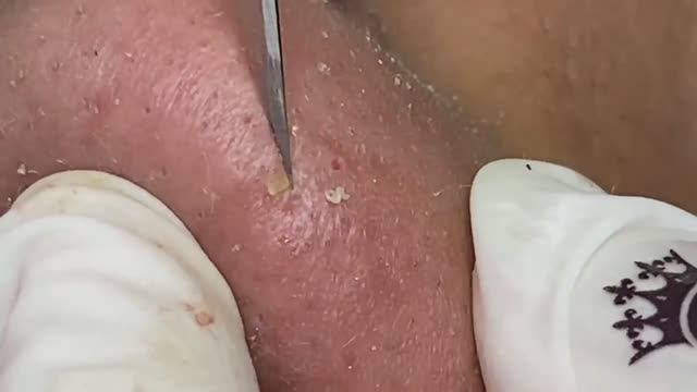 Fire! Битва с черными точками на носу: самое зрелищное удаление! смотреть онлайн