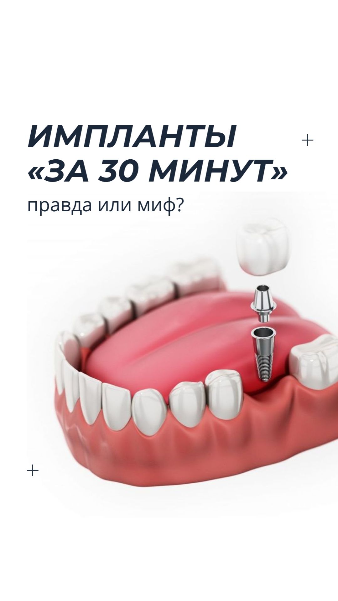 Импланты за 30 минут звучит привлекательно  но всегда ли это безопасно? shots