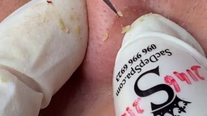 Выдавливание прыщей, угрей, черных точек и камедонов #44