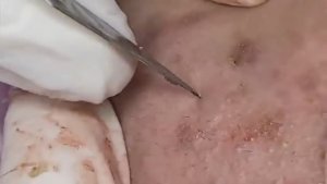 САМЫЕ УПРЯМЫЕ черные точки скрывающиеся глубоко под кожей!