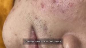 Asmr. Механическое очищение от прыщей и сальных пробок. 90394