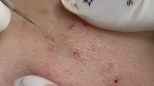 Лечения акне у одного клиента. Третий сеанс