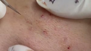 Лечения акне у одного клиента. Третий сеанс