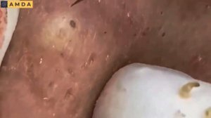 Asmr. Чистим лицо от угней и сальных пробок _ 2146