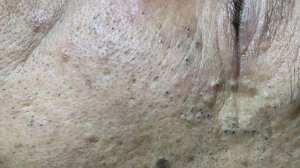 Чистка лица от прыщей: быстро и эффективно. 2176