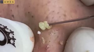 Asmr. Профессиональная чистка от черных точек и сальных пробок. 12142