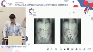 Семь лет работы Центра по лечению внезапной смерти Прасол Д.М. 2025