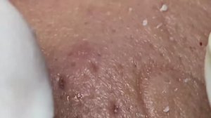 Профессиональное удаление комедонов: тонкая работа мастера. 2171