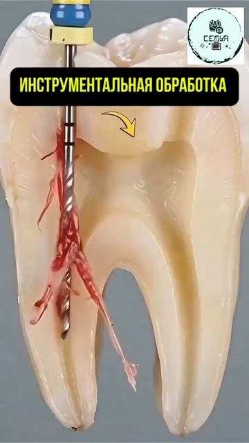 НАГЛЯДНОЕ ЛЕЧЕНИЕ МНОГОКОРНЕВОГО ОСЛОЖНЕННОГО КАРИЕСА смотреть онлайн