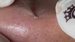 Полная чистка пор на носу! Удовлетворяющее видео. #чистканоса