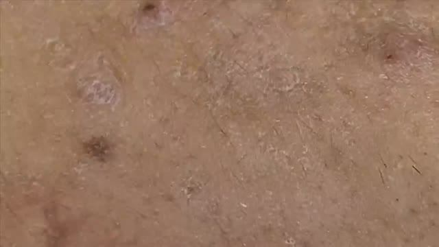 Извлечение чёрных точек и белых угрей | Увлекательное видео