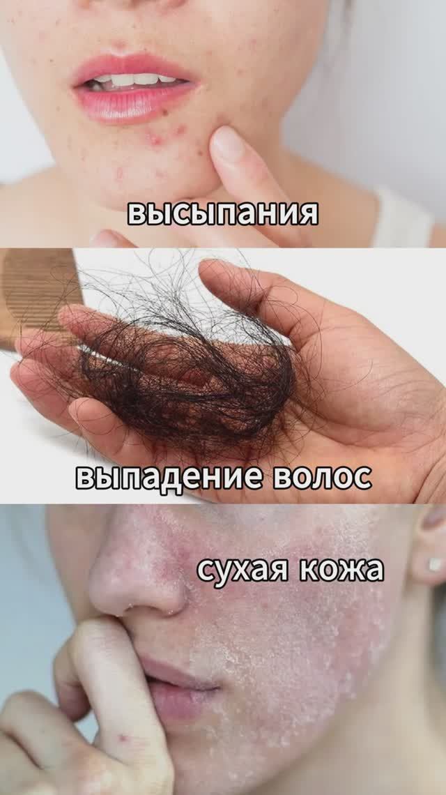 выпадение волос, сухая кожа смотреть онлайн