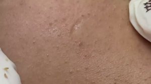 Эффективное лечение чёрных точек #черныеточки #чисткалица #проблемнаякожа