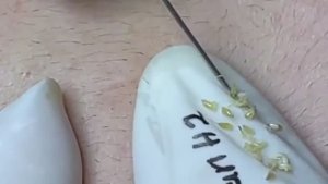 Relax Acne 022 • АСМР • Loan Nguyen collection