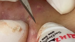 Выдавливание прыщей, угрей, черных точек и камедонов #47