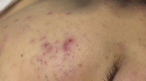 Механическая чистка от воспаленных прыщей #121