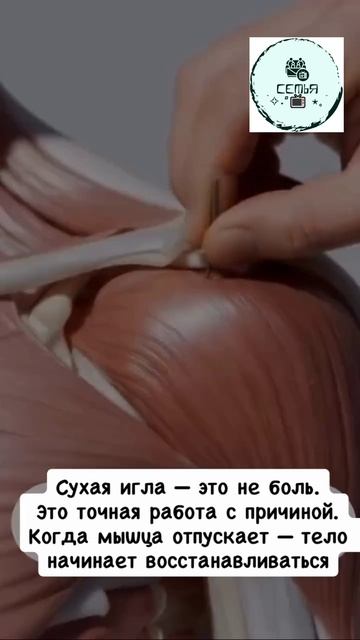 НАГЛЯДНАЯ ТОЧНАЯ РАБОТА ИГЛОЙ ДЛЯ РАСЩЕМЛЕНИЯ МЫШЦЫ смотреть онлайн