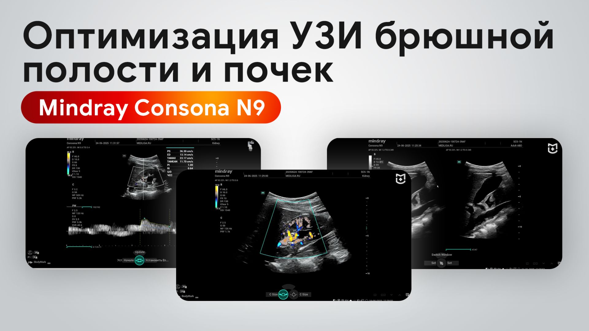 Оптимизация изображения при исследовании брюшной полости и почек на Mindray Consona N9 смотреть онлайн