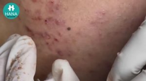 Asmr. Чистка кожи от черных точек. #05