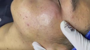 Чёрные точки и скрытые прыщи под кожей | Угри, комедоны