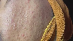 Угри на лбу и глубокие стойкие чёрные точки: удаление