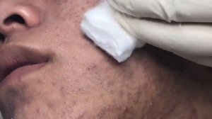 Лечение воспалённых прыщей и чёрных точек в салоне