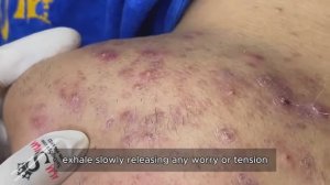 Профессиональное удаление комедонов на носу и подбородке #90329