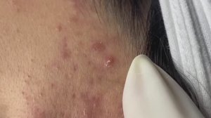 Избавляемся от прыщей и восстанавливаем кожный барьер #124 #чисткалица  #прыщи