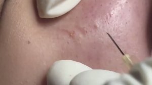 Боремся с акне всех типов: воспаления, подкожные прыщи и чёрные точки. Часть - 33