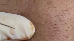 Продолжение истории про удаление черных точек.