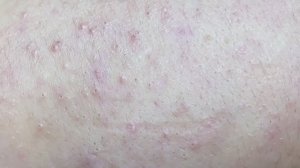 Удаление жирных прыщей, угрей, черных точек, воспаленных прыщей