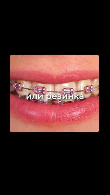 Лигатурные брекеты