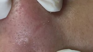 Чистим лицо от прыщей: этапы удаления.