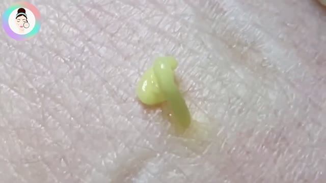 Чистка пор, воспаленные прыщи, глубокие подкожные прыщи.