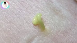 Чистка пор, воспаленные прыщи, глубокие подкожные прыщи.