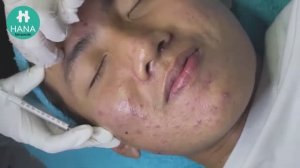 Asmr. Лечение от черных точек и сальных пробок. #04