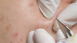 Полное удаление черных точек и скрытых прыщей для девушек - ThuyTruong #4