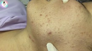 Выдавливание черных точек, комедонов. #удалениепрыщей #выдавливаниежирныхпрыщей.