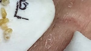 Выдавливание прыщей, угрей, черных точек и камедонов #55