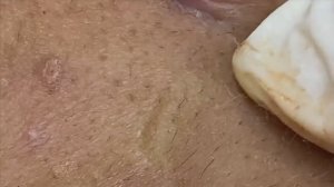 Чёрные точки — Часть 2. Большие комедоны и их удаление.