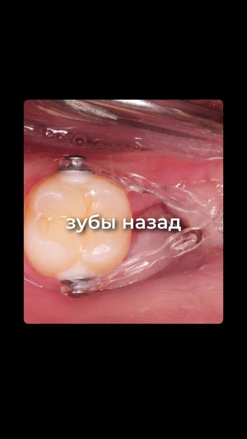 Удаление премоляров