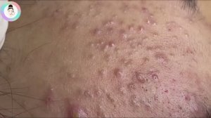 Выдавливание и удаление прыщей — приятного просмотра!