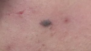 Полное удаление прыщей вокруг шеи от ThuyTruong#1