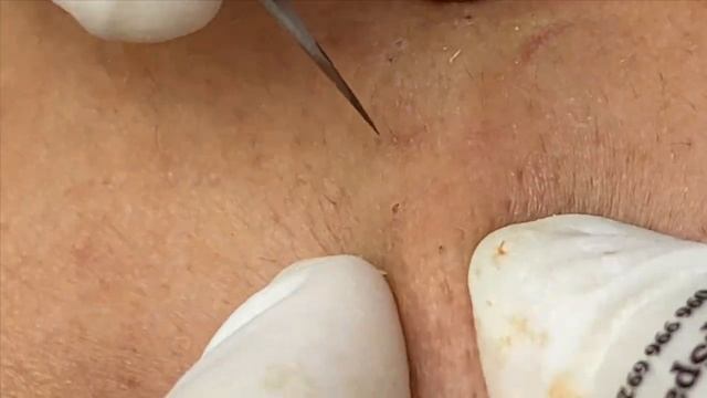 Угревая болезнь: сложный путь к чистой коже смотреть онлайн