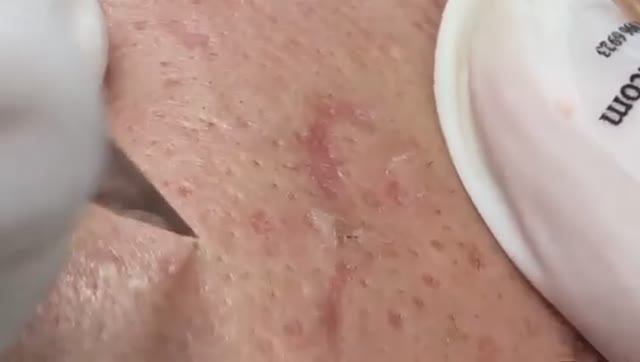 Полное удаление скрытых прыщей и белых угрей от ThuyTruong#5