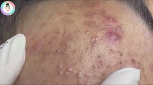Выдавливание жирных прыщей на лбу