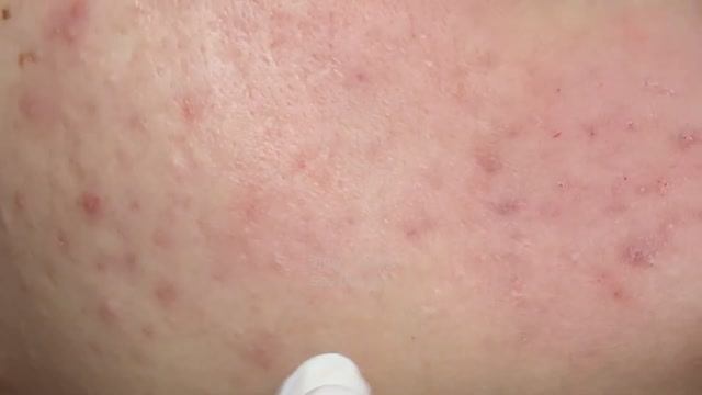 Застарелые скрытые прыщи приводят к образованию шрамов - ThuyTruong #2