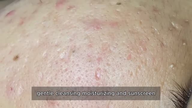 Asmr. Профессиональное удаление от черных точек. 90336