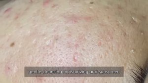 Asmr. Профессиональное удаление от черных точек. 90336