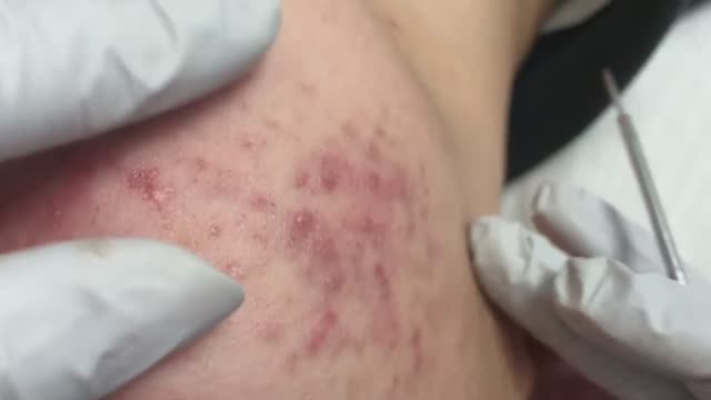 Удаление акне: от комедонов до кистозных прыщей